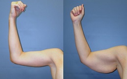 Arm Lift Brachioplasty surgery in Islamabad