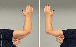 Arm Lift treatment in Islamabad