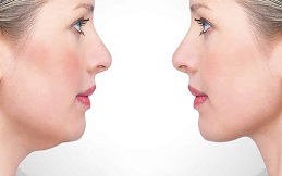 Belkyra Treatment before after results