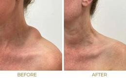 Best lipoma before after
