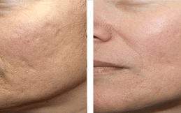 Best Aquagold Fine Touch Treatment