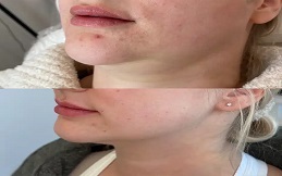 Best Belkyra Treatment