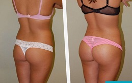 Best Brazilian Butt Lift in Islamabad