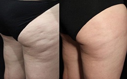Best Cellulite treatment