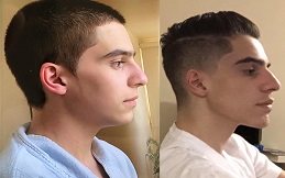 Best Chin Augmentation in Islamabad