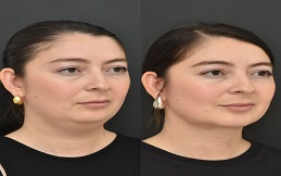 Best Chin Augmentation treatment in Islamabad