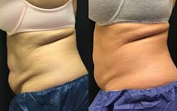 Best Cool Sculpting in Islamabad