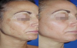 Best Cosmelan Peeling
