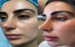 Best Cosmetic Injectables