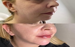 Best Fractional Laser And PRP Therapy in Islamabad