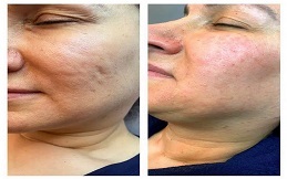 Best Fractional Laser And PRP Therapy