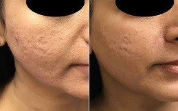 Best Fractional RF Microneedling