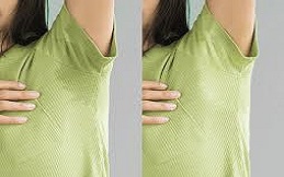 Best Hyperhidrosis in Islamabad