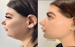 Best Kybella Treatment in Islamabad