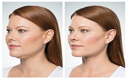 Best Kybella in Islamabad