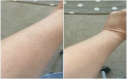 Best Laser Hair Bleaching in Islamabad