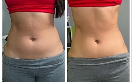 Best Liposonix treatment