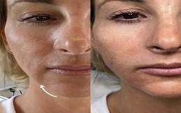 Best Nano Thread Lift before after