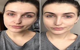 Best Nano Thread Lift treatment