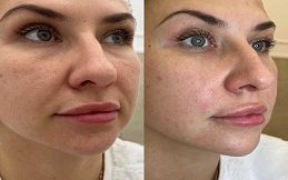 Best Nano Thread Lift