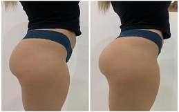 Best Non-Surgical Bum Lift