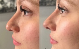Best Nose fillers in Islamabad