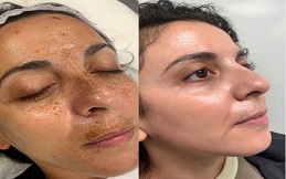 Best PICO Laser in Islamabad