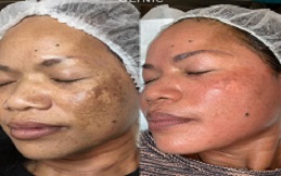 Best Removal Of Melasma And pigmentation treatment