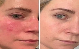 Best Rosacea Treatment