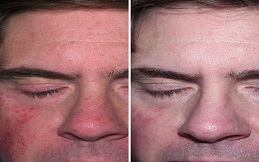 Best-Rosacea-Treatment-in-Islamabad