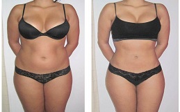Best Sculpsure Body Contouring