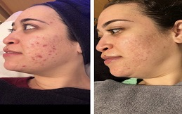 Best Spectra Laser Carbon Peel in Islamabad