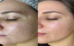 Best Spectra Laser Carbon Peel