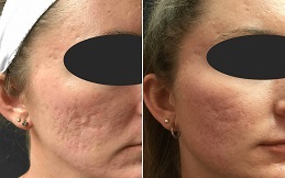 Best Subcision Treatment for Acne Scars