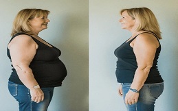 Best Tummy Tuck treatment in Islamabad