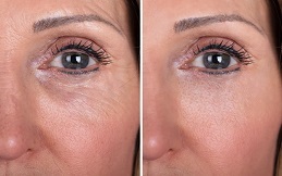 Best Ultherapy Treatment