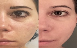 Best Under Eye fillers in Islamabad
