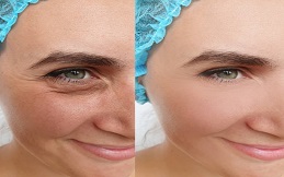 Best under eye fillers