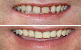 Best dental clinic for invisible braces