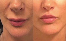 Best lip reduction in Islamabad