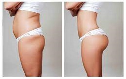 Body Contouring Treatment in Islamabad