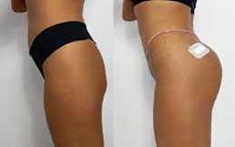 Body fillers in Islamabad