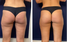 Body contouring before after results