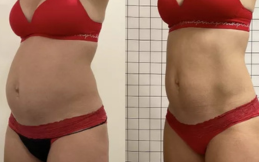 Body contouring results