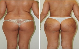 Brazilian Butt Lift before after results