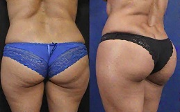 Brazilian Butt Lift before after