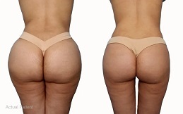 Brazilian Butt Lift surgery in ISlamabad