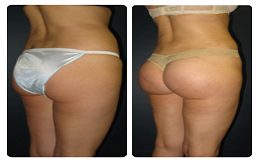 Brazilian Butt Lift treatment in Islamabad