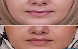 Bullhorn Lip Lift before after results