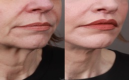 Bullhorn Lip Lift before after